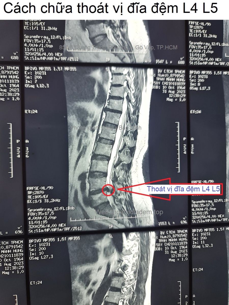 Cách chữa thoát vị đĩa đệm L4 L5